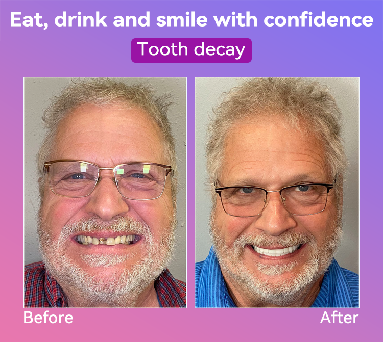 ๐๐๐ฌ๐ฌ๐๐๐ฆยฎ Latest Premium Comfort Dentures๐ (High-End Dentures, Easy to Wear - Limited Time 70% Discount)๐ฅ