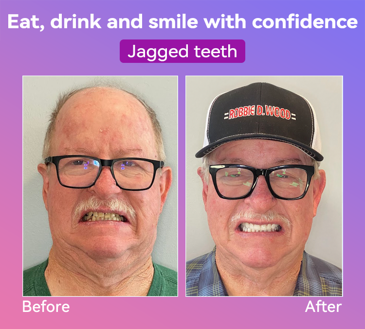 𝐉𝐚𝐬𝐬𝐞𝐞𝐦® Latest Premium Comfort Dentures🎁 (High-End Dentures, Easy to Wear - Limited Time 70% Discount)