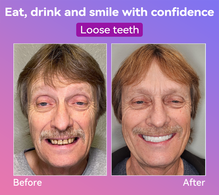 𝐉𝐚𝐬𝐬𝐞𝐞𝐦® Latest Premium Comfort Dentures🎁 (High-End Dentures, Easy to Wear - Limited Time 70% Discount)