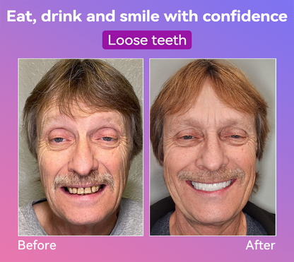 𝐉𝐚𝐬𝐬𝐞𝐞𝐦® Latest Premium Comfort Dentures🎁 (High-End Dentures, Easy to Wear - Limited Time 70% Discount)